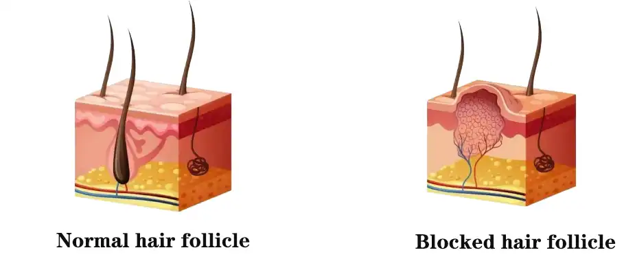 Blocked plaub hau follicle.jpg