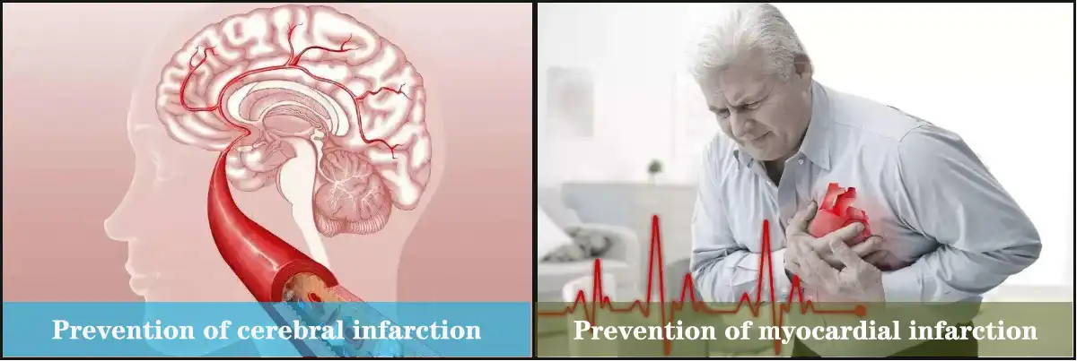 Tiv thaiv myocardial infarction.jpg
