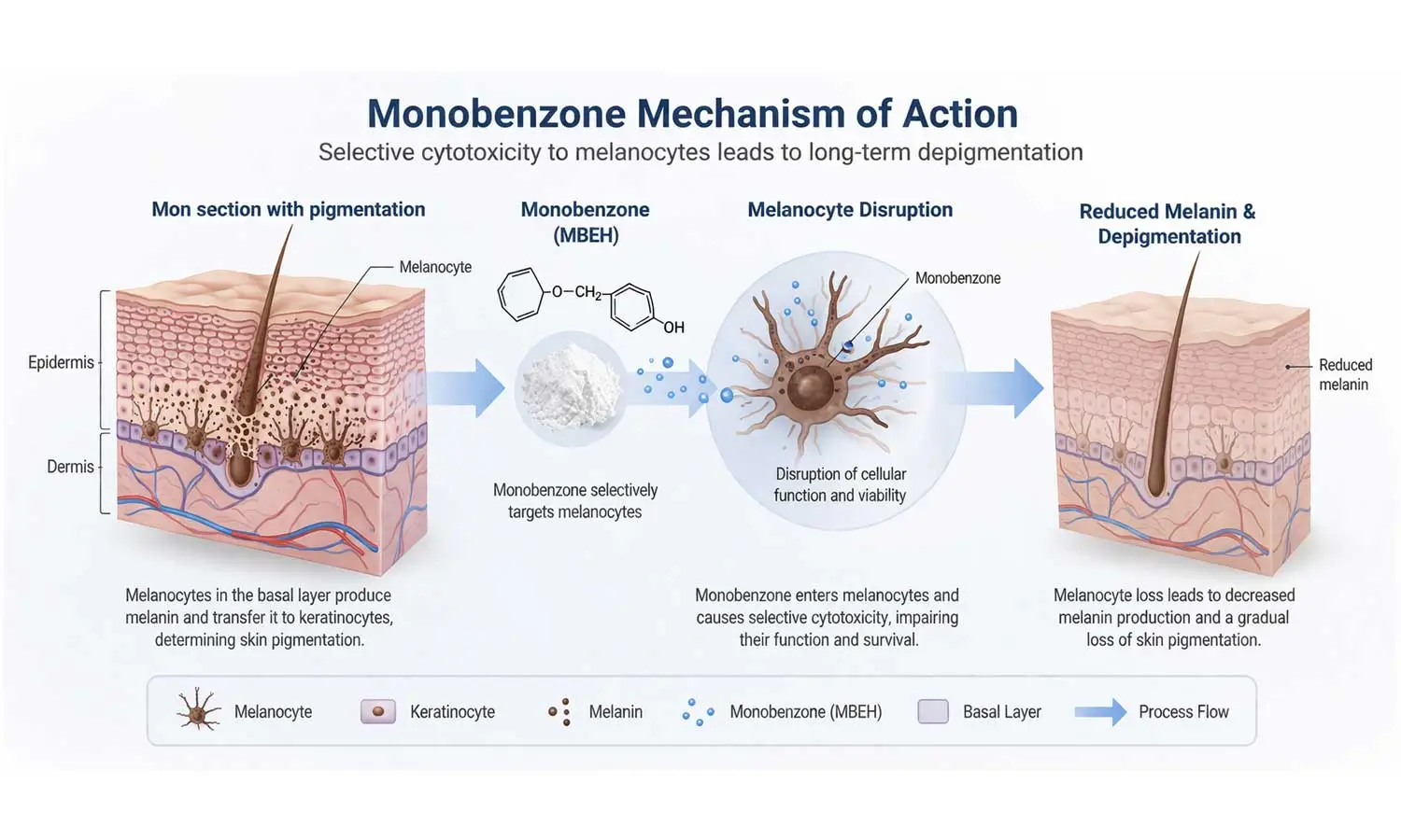 monobenzone-mechanism-depigmentation